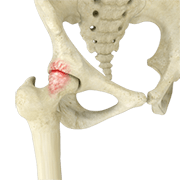 Femoroacetabular Impingement/ Hip Impingement