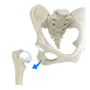 Surgical Hip Dislocation