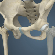 Fracture Repair Surgery - Plates and Screws, IM Rod, External Fixator